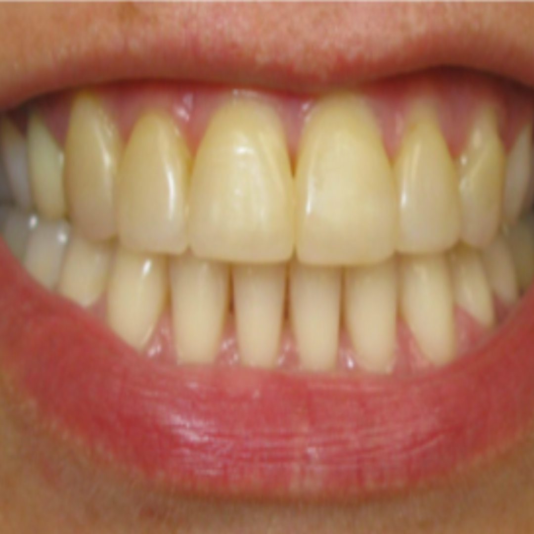yellowish tooth